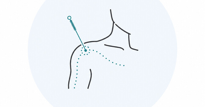 Acupuncture